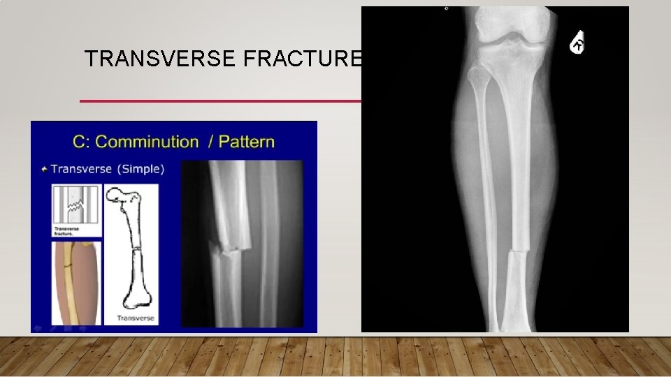 TRANSVERSE FRACTURE 