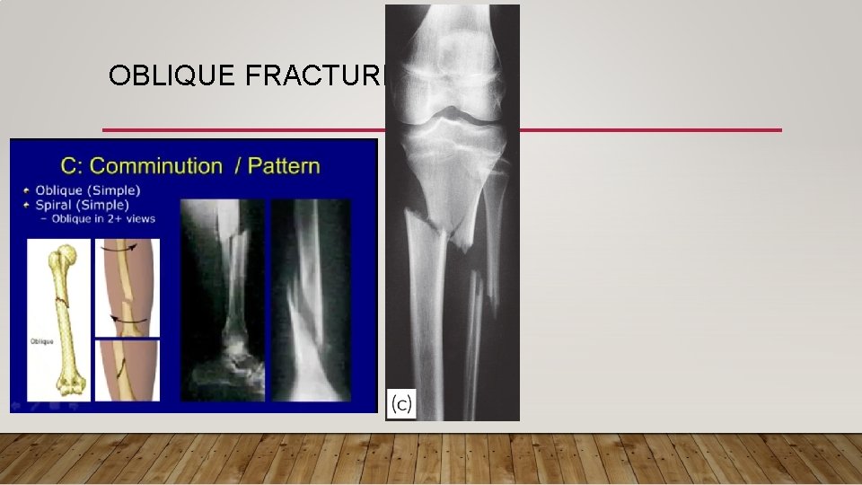 OBLIQUE FRACTURE 