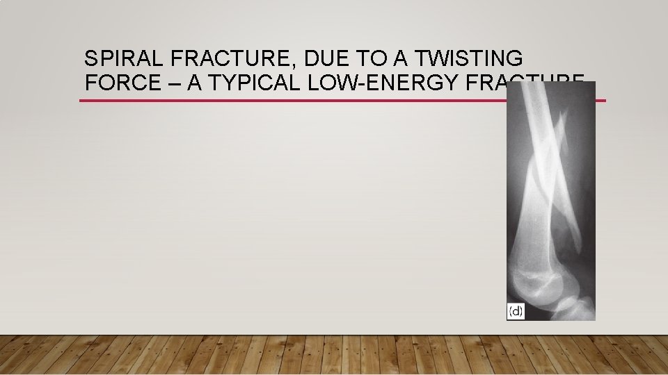 SPIRAL FRACTURE, DUE TO A TWISTING FORCE – A TYPICAL LOW-ENERGY FRACTURE 