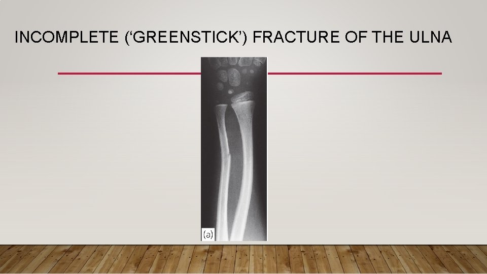 INCOMPLETE (‘GREENSTICK’) FRACTURE OF THE ULNA 