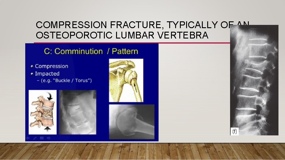COMPRESSION FRACTURE, TYPICALLY OF AN OSTEOPOROTIC LUMBAR VERTEBRA 