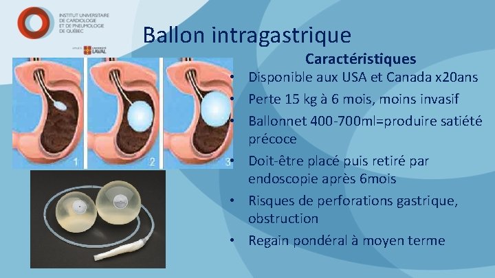 Ballon intragastrique Caractéristiques • Disponible aux USA et Canada x 20 ans • Perte