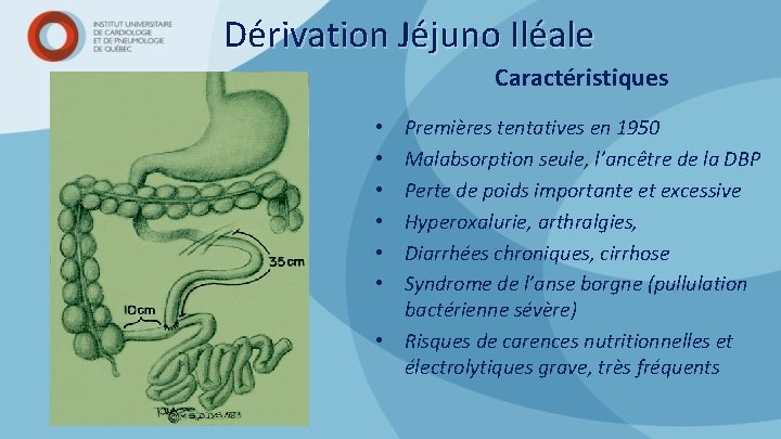 Dérivation Jéjuno Iléale Caractéristiques Premières tentatives en 1950 Malabsorption seule, l’ancêtre de la DBP