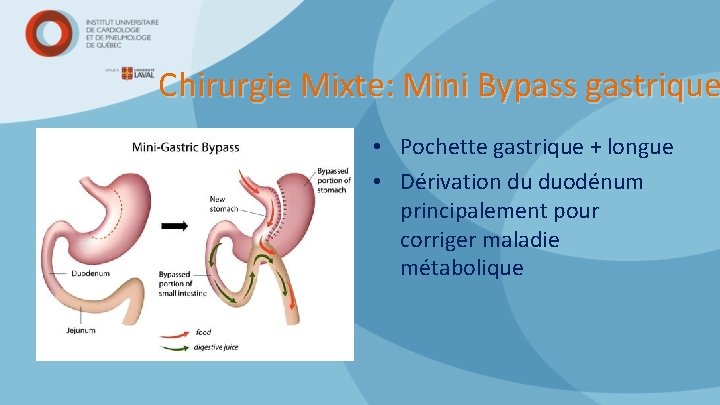 Chirurgie Mixte: Mini Bypass gastrique • Pochette gastrique + longue • Dérivation du duodénum