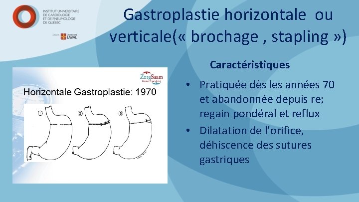 Gastroplastie horizontale ou verticale( « brochage , stapling » ) Caractéristiques • Pratiquée dès