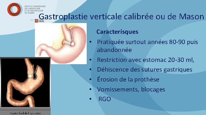 Gastroplastie verticale calibrée ou de Mason Caracterisques • Pratiquée surtout années 80 -90 puis