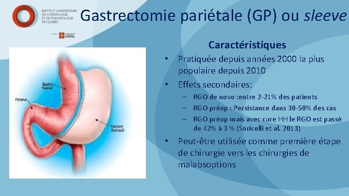 Gastrectomie pariétale (GP) ou sleeve Caractéristiques • Pratiquée depuis années 2000 la plus populaire