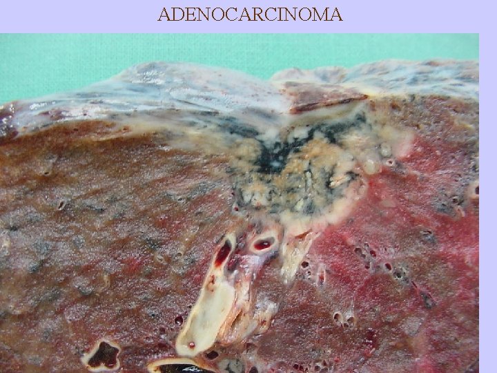 ADENOCARCINOMA 