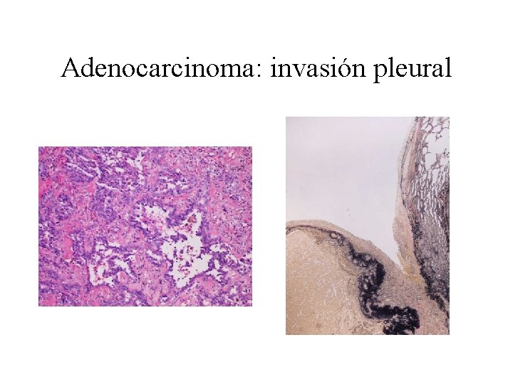 Adenocarcinoma: invasión pleural 