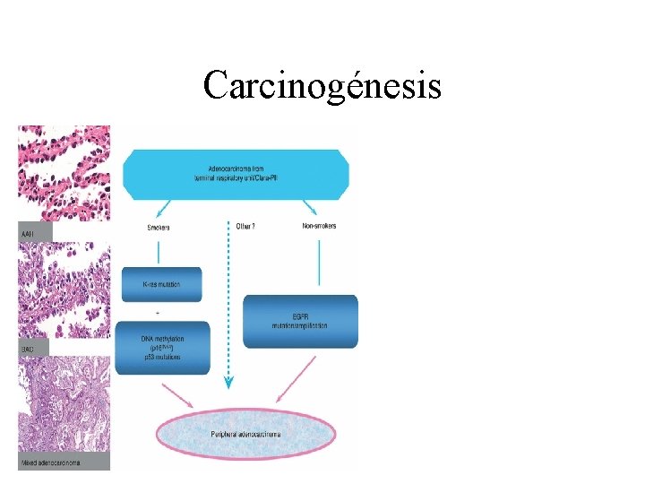 Carcinogénesis 