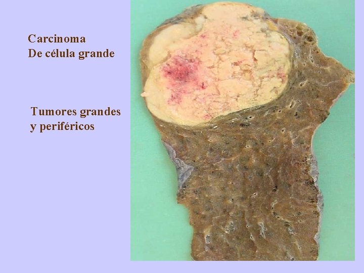 Carcinoma De célula grande Tumores grandes y periféricos 