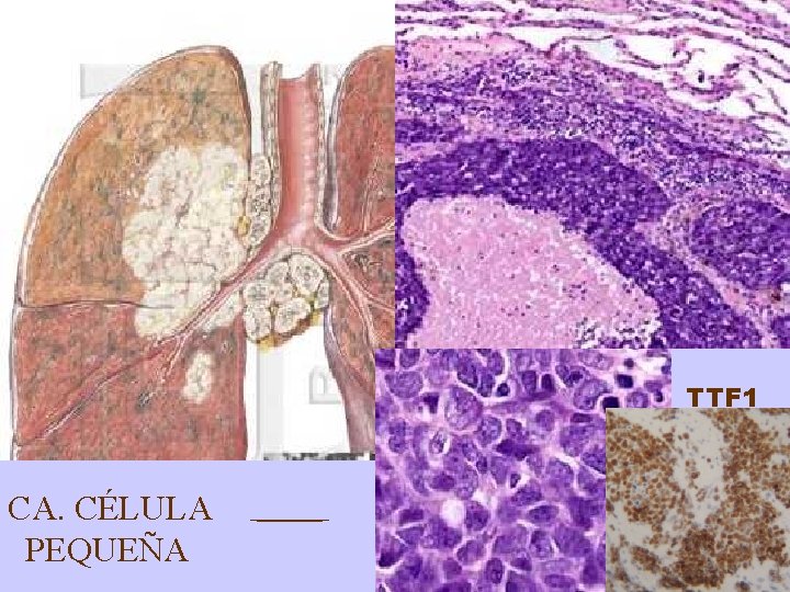 TTF 1 CA. CÉLULA PEQUEÑA 