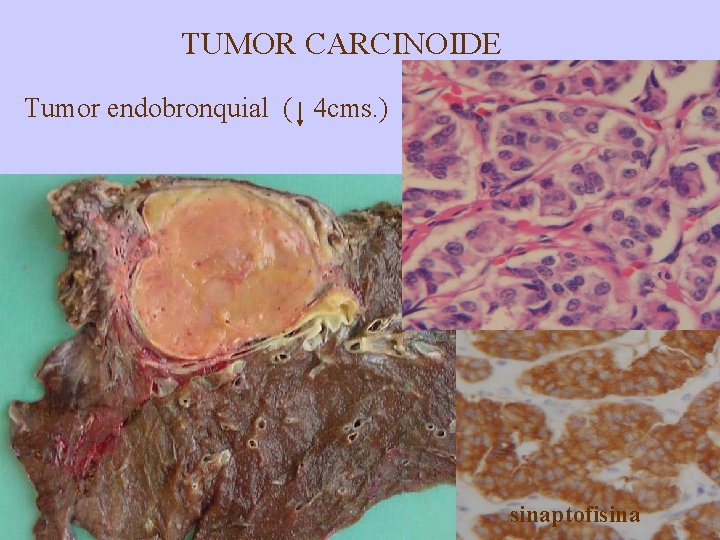 TUMOR CARCINOIDE Tumor endobronquial ( 4 cms. ) sinaptofisina 