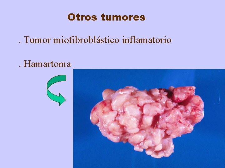Otros tumores. Tumor miofibroblástico inflamatorio. Hamartoma 