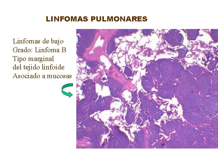 LINFOMAS PULMONARES Linfomas de bajo Grado: Linfoma B Tipo marginal del tejido linfoide Asociado
