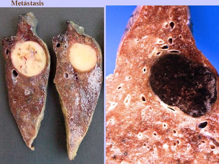 Metástasis 