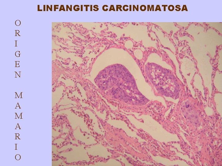 LINFANGITIS CARCINOMATOSA O R I G E N M A R I O 