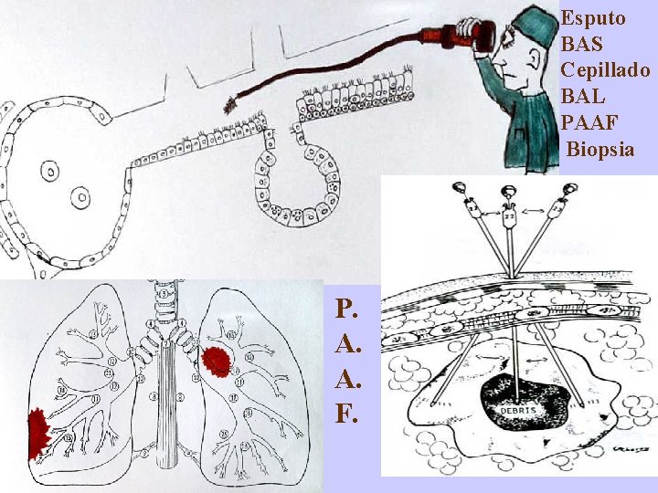 Esputo BAS Cepillado BAL PAAF Biopsia P. A. A. F. 