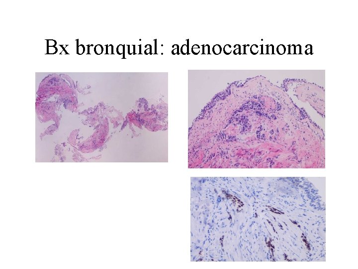 Bx bronquial: adenocarcinoma 