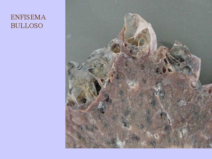 ENFISEMA BULLOSO 