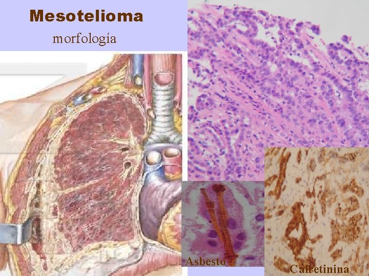 Mesotelioma morfología histología Asbesto asbesto Calretinina 