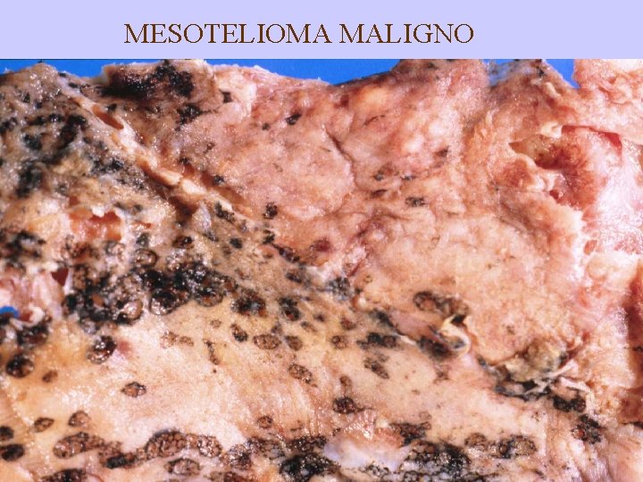 MESOTELIOMA MALIGNO 