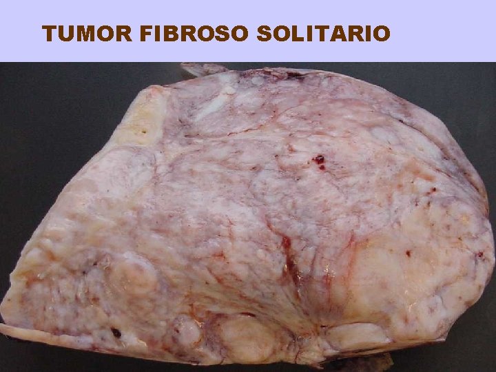 TUMOR FIBROSO SOLITARIO 