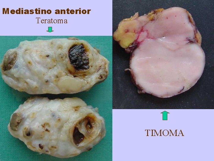 Mediastino anterior Teratoma TIMOMA 