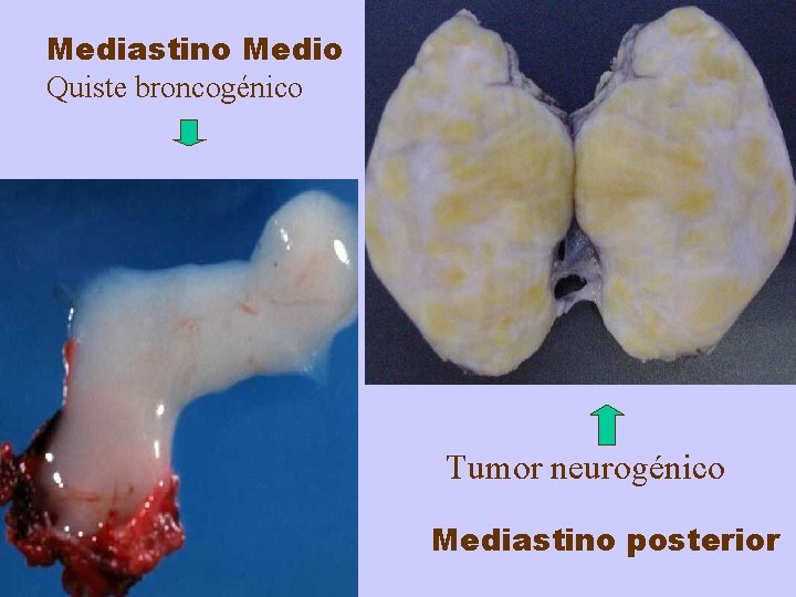 Mediastino Medio Quiste broncogénico Tumor neurogénico Mediastino posterior 