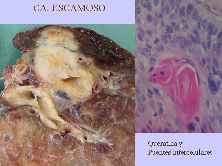 CA. ESCAMOSO Queratina y Puentes intercelulares 