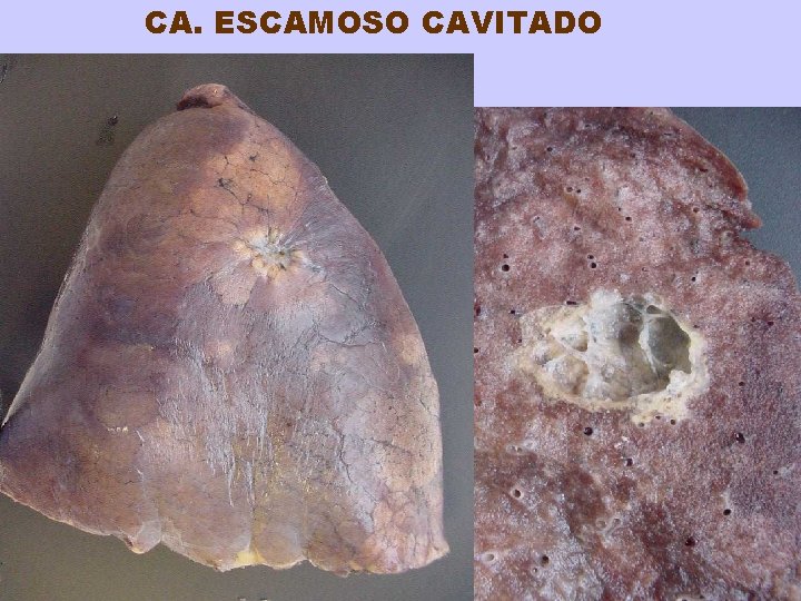 CA. ESCAMOSO CAVITADO 