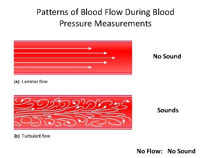 Patterns of Blood Flow During Blood Pressure Measurements No Sounds No Flow: No Sound