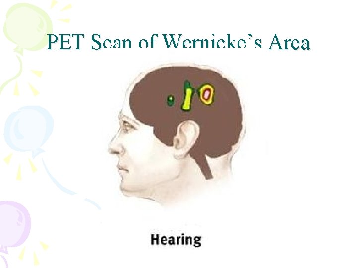 PET Scan of Wernicke’s Area 