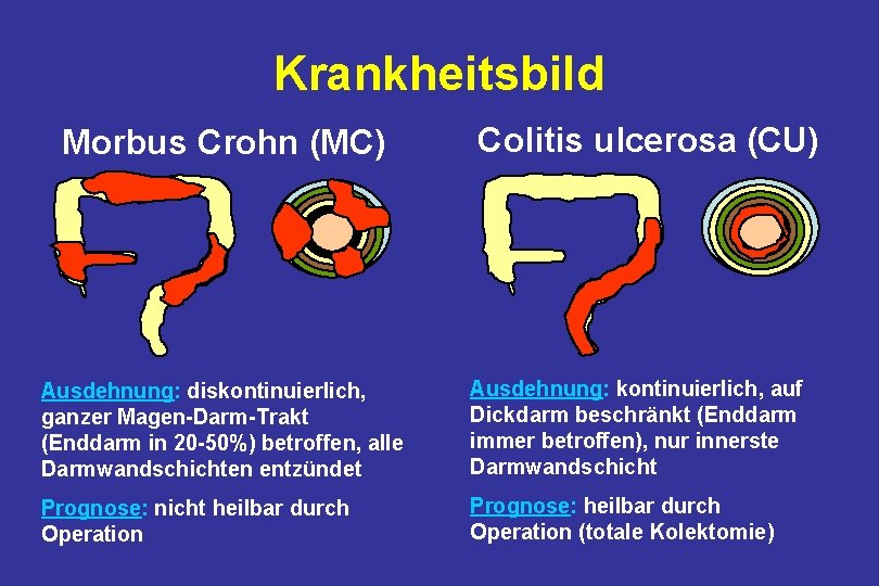 Krankheitsbild Morbus Crohn (MC) Colitis ulcerosa (CU) Ausdehnung: diskontinuierlich, ganzer Magen-Darm-Trakt (Enddarm in 20