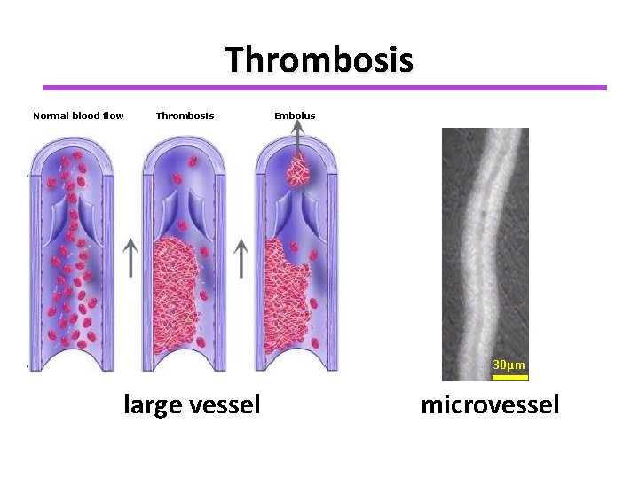 Thrombosis Normal blood flow Thrombosis Embolus 30µm large vessel microvessel 