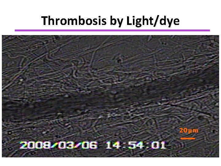 Thrombosis by Light/dye 20µm 