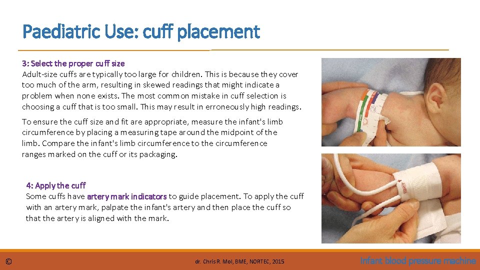 Paediatric Use: cuff placement 3: Select the proper cuff size Adult-size cuffs are typically