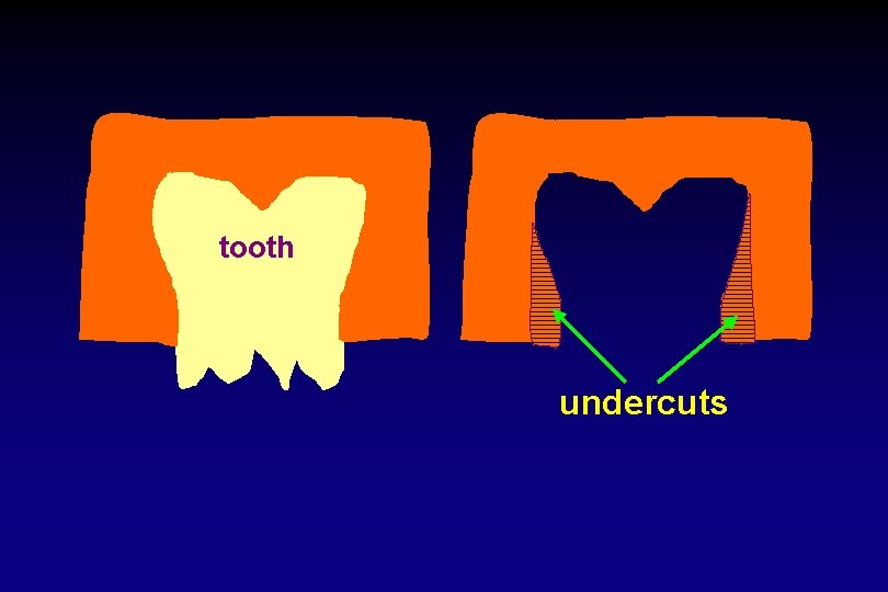 tooth undercuts 