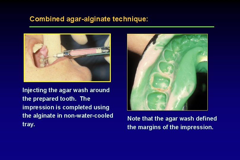 Combined agar-alginate technique: Injecting the agar wash around the prepared tooth. The impression is