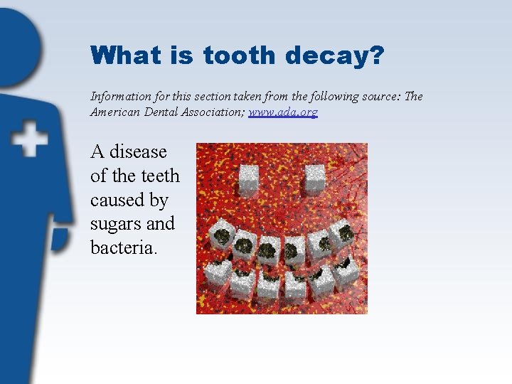 What is tooth decay? Information for this section taken from the following source: The