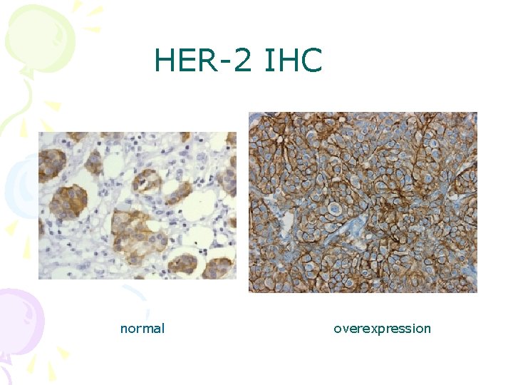 HER-2 IHC normal overexpression 