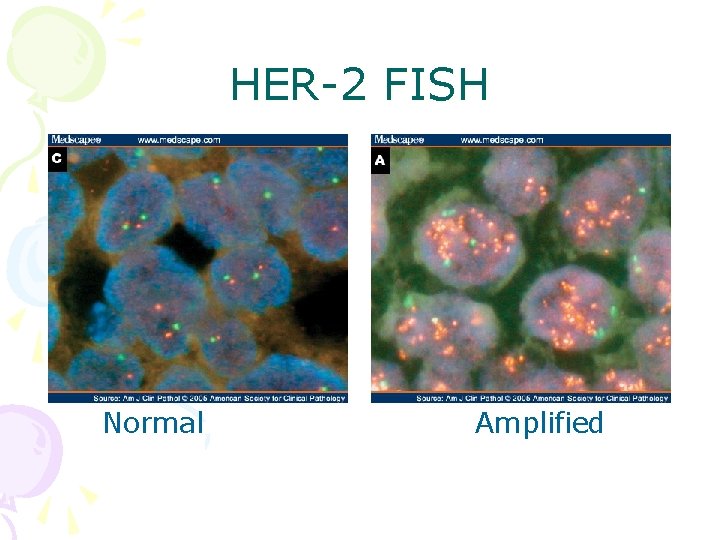 HER-2 FISH Normal Amplified 