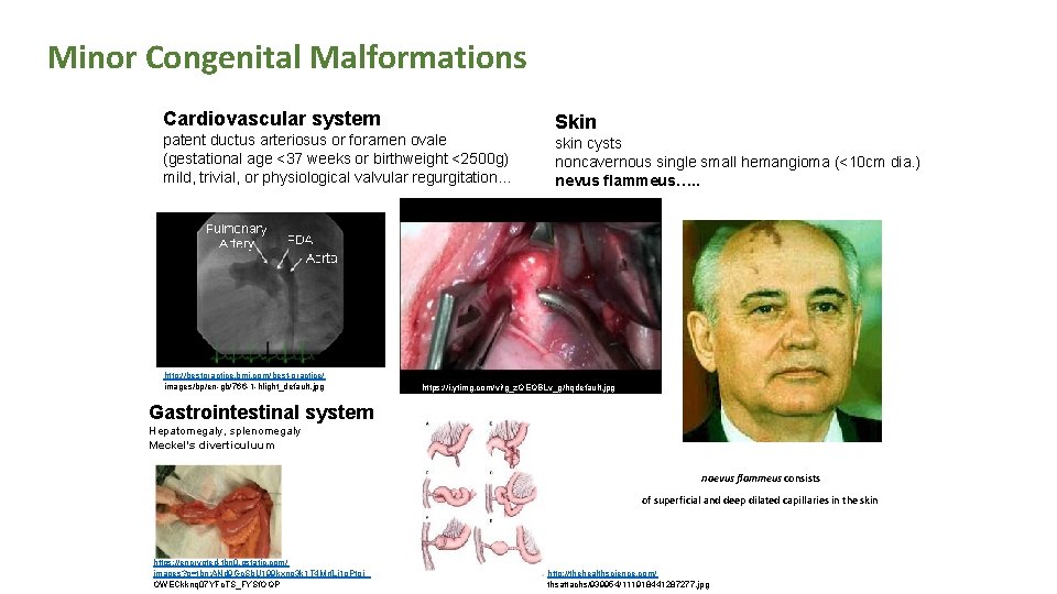 Minor Congenital Malformations Cardiovascular system patent ductus arteriosus or foramen ovale (gestational age <37