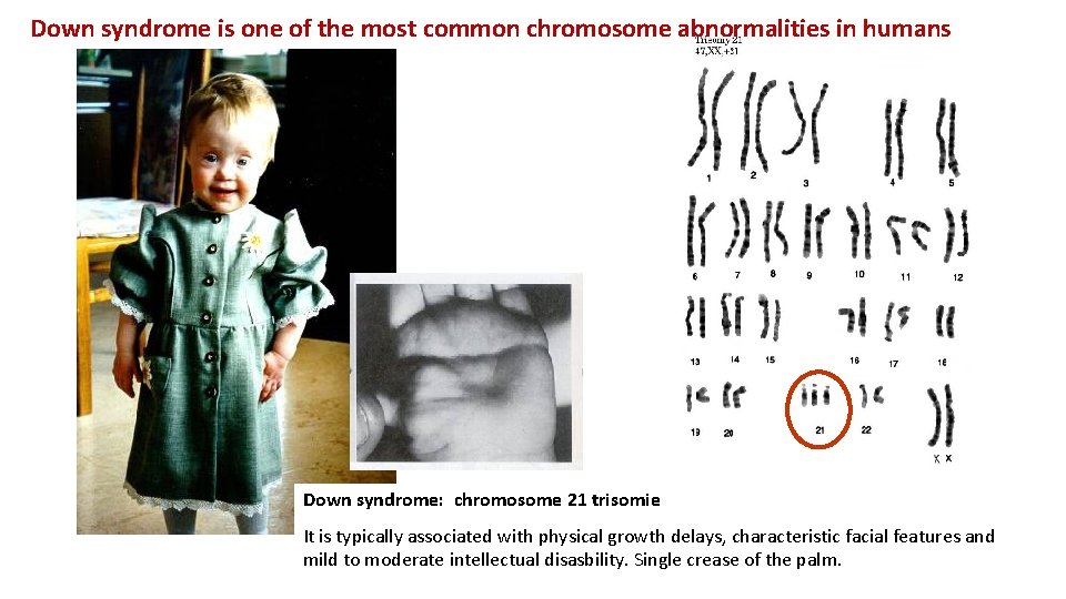 Down syndrome is one of the most common chromosome abnormalities in humans Down syndrome: