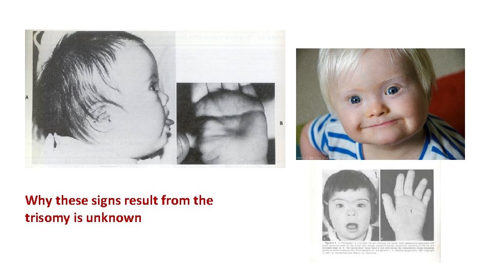 Why these signs result from the trisomy is unknown 