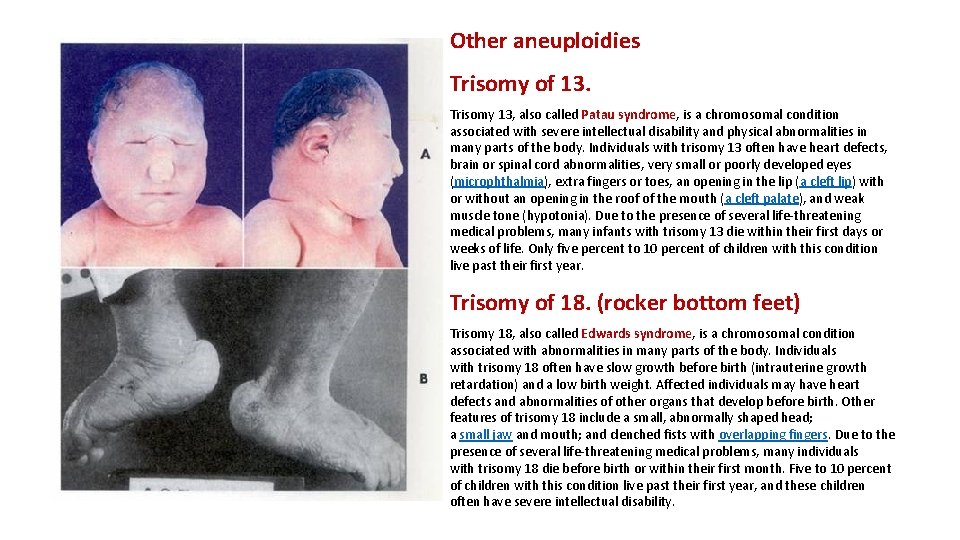 Other aneuploidies Trisomy of 13. Trisomy 13, also called Patau syndrome, is a chromosomal