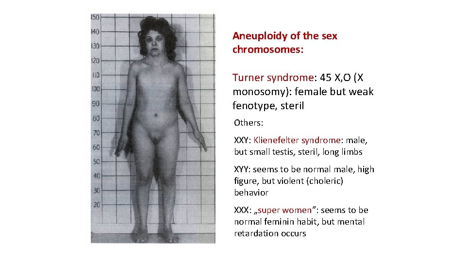 Aneuploidy of the sex chromosomes: Turner syndrome: 45 X, O (X monosomy): female but