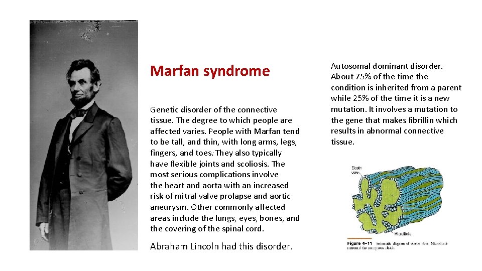 Marfan syndrome Genetic disorder of the connective tissue. The degree to which people are