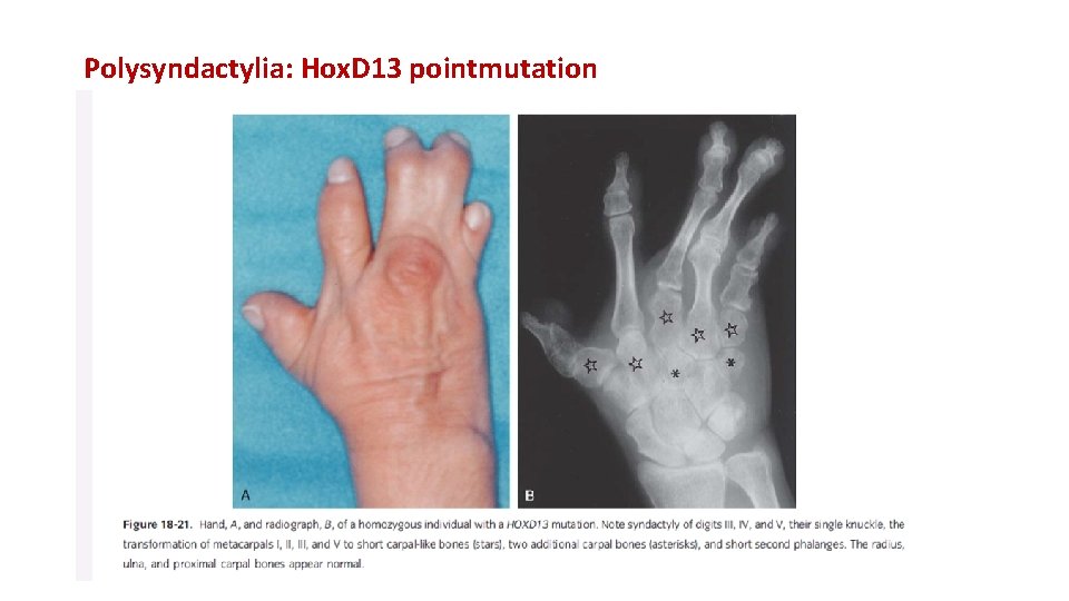 Polysyndactylia: Hox. D 13 pointmutation Syndaktilia: az ujjak összeolvadása. Ebben a humán esetben a