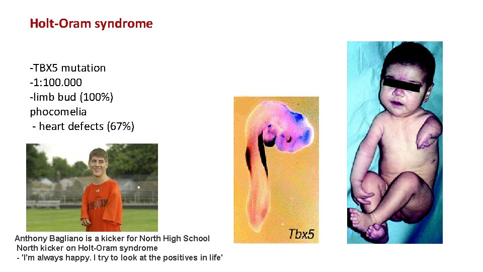 Holt-Oram syndrome -TBX 5 mutation -1: 100. 000 -limb bud (100%) phocomelia - heart